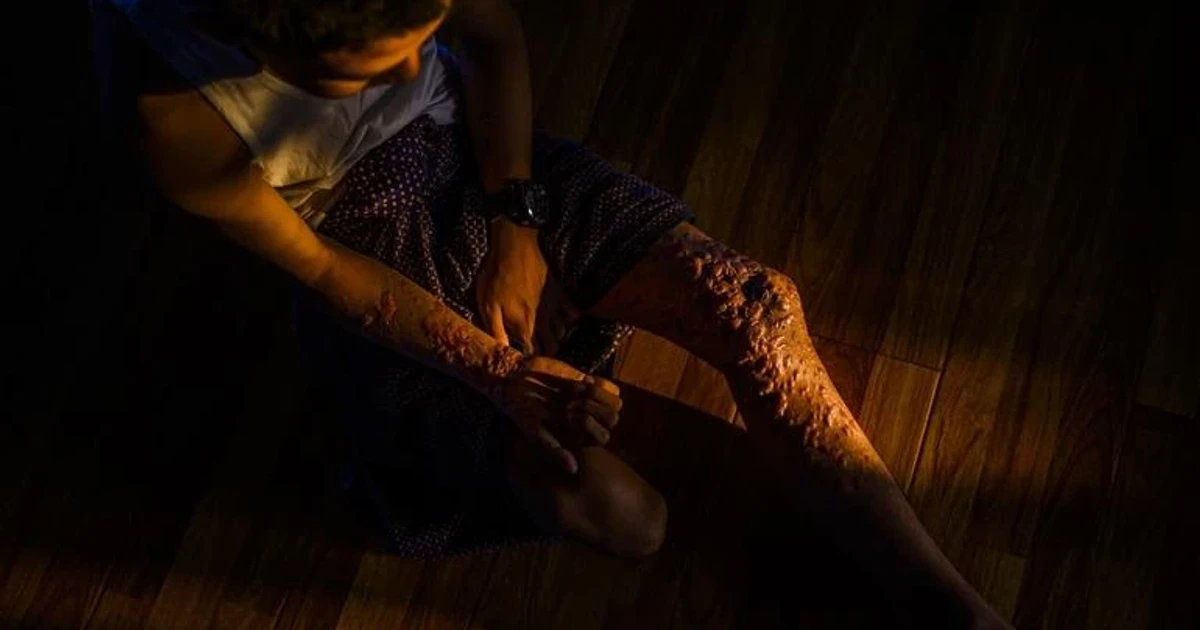 Myanmar’s landmine crisis surges after coup, children among victims
