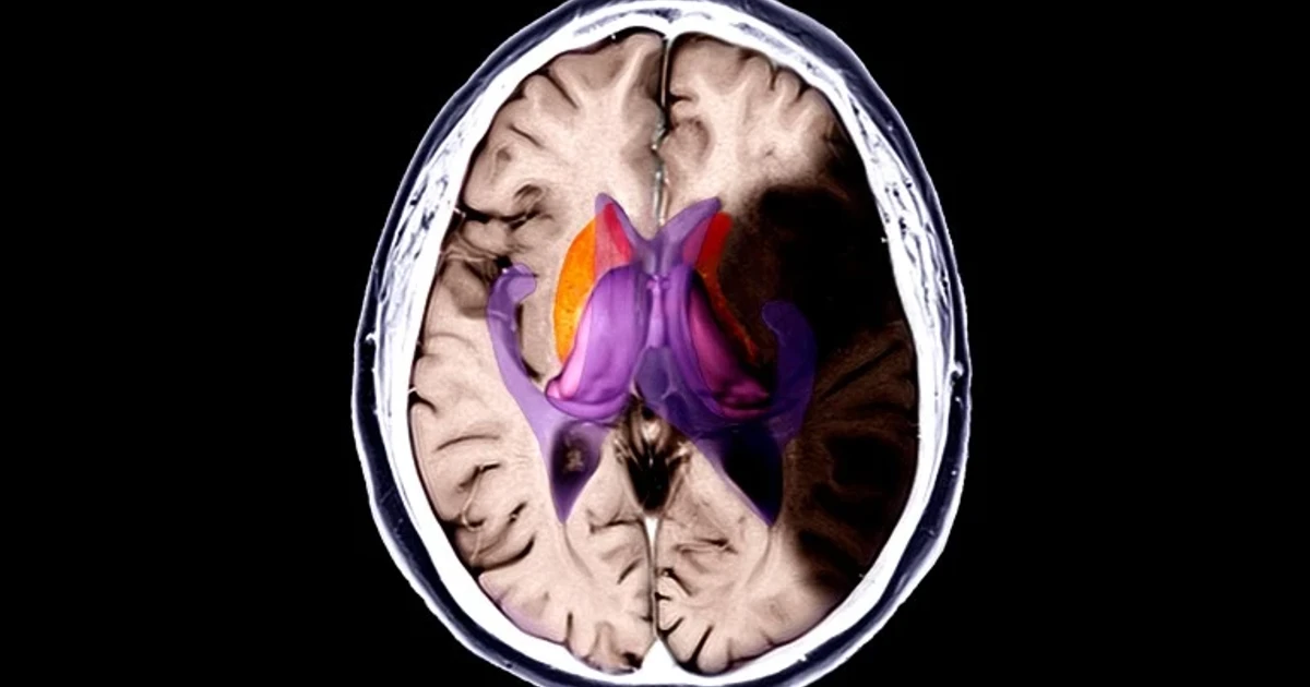 Drug combo induces hypothermia in animals to limit stroke damage