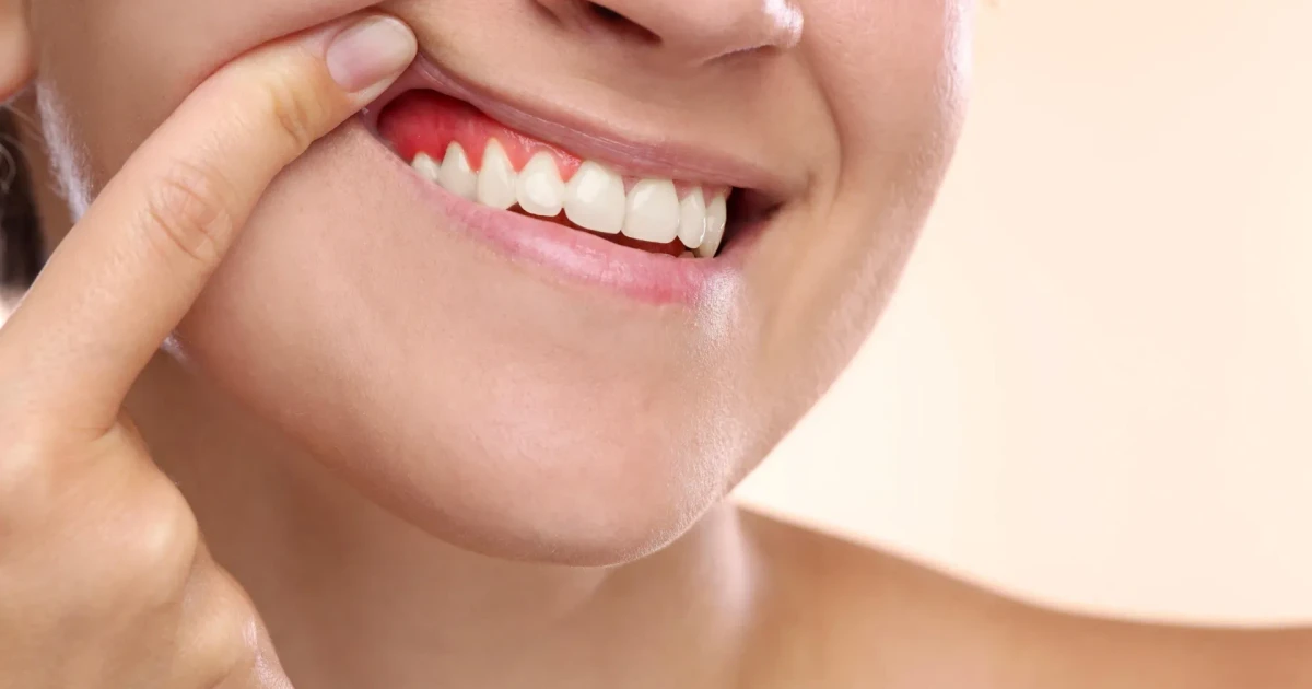 Brazilian researchers test biomaterial to heal severe gum disease
