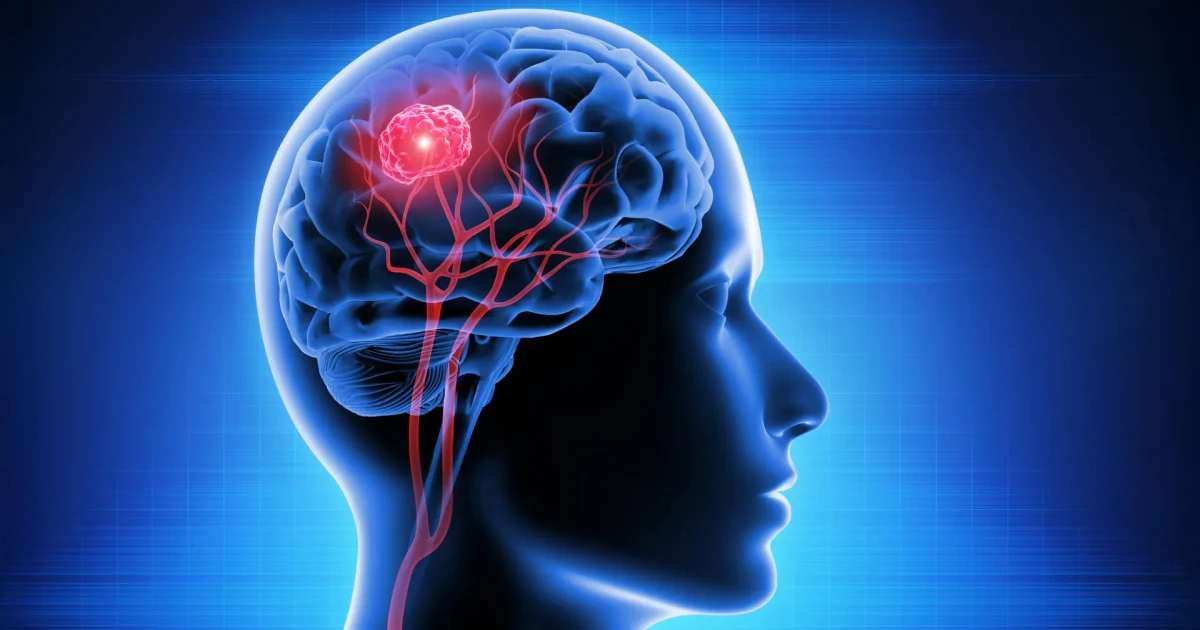 Vitamin B12 compound shows promise against deadly glioblastoma