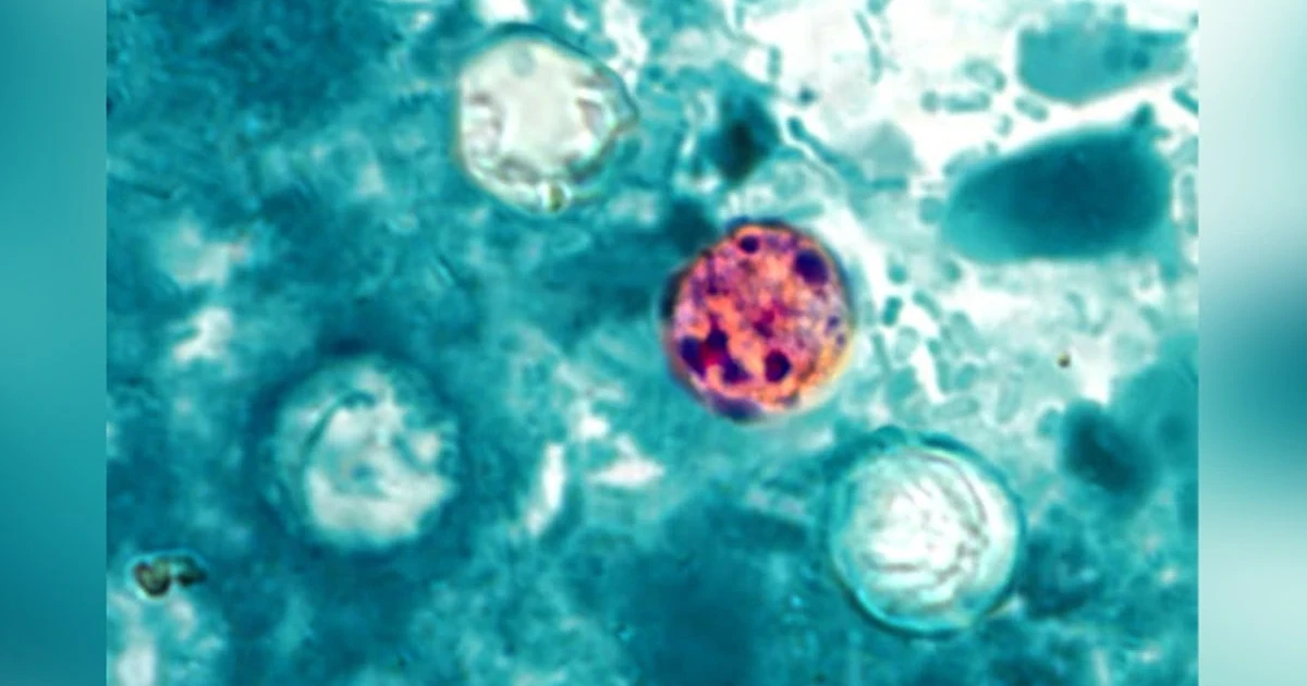 Cyclospora cases rise across 17 states, North Carolina sees 60 plus