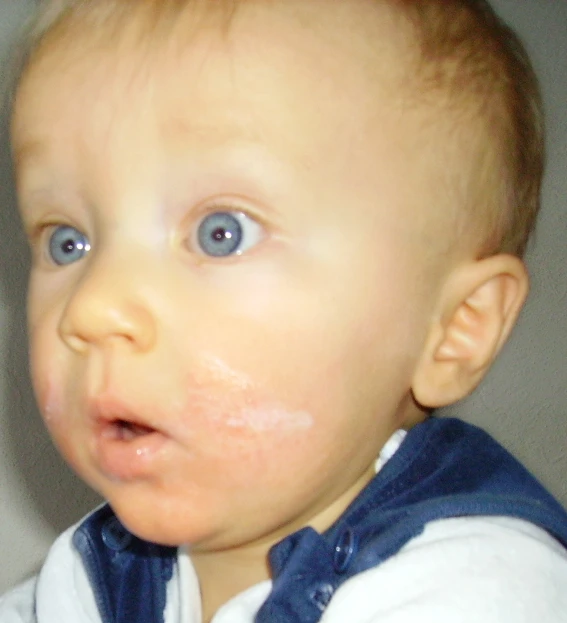 atopic dermatitis — Wikimedia Commons