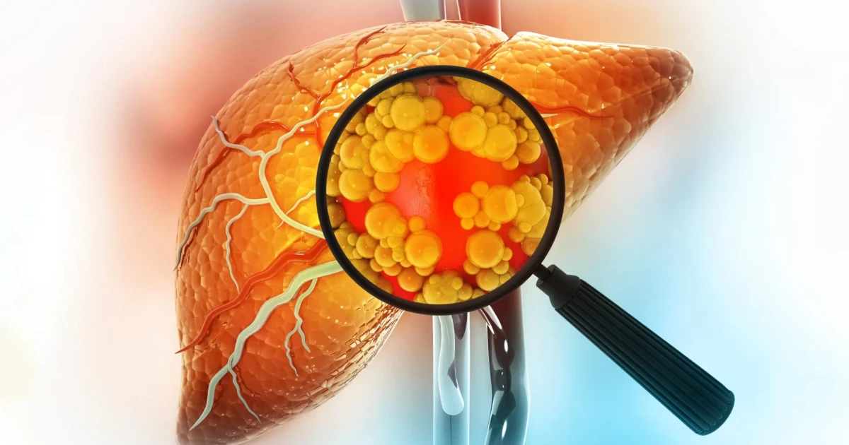 Michigan Medicine compound reverses fatty liver disease by repairing gut