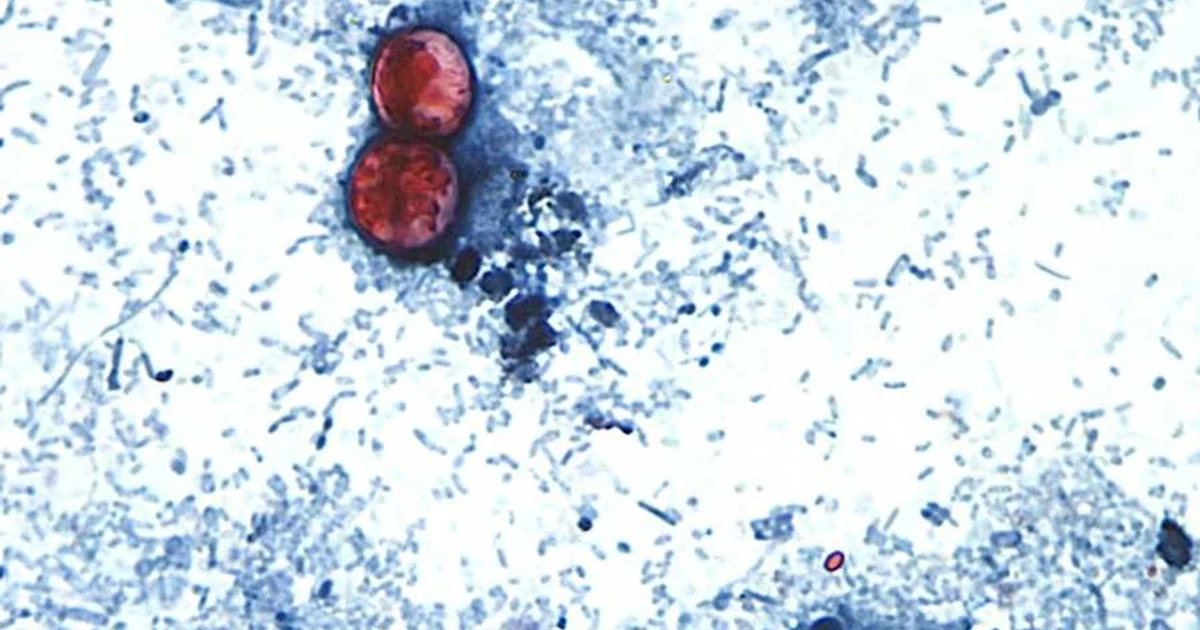 Two cyclospora cases confirmed in New Hampshire, health officials say