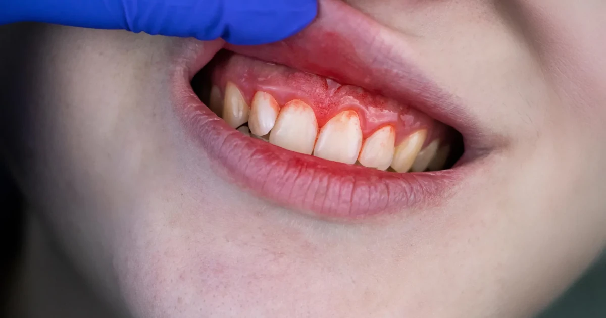 Study links gum disease bacteria to hardened heart valves