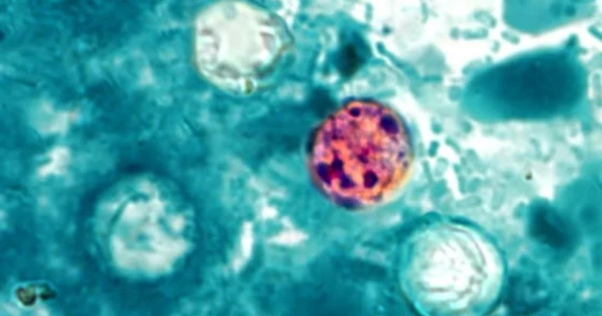 Cyclospora outbreak sickens 843 across 31 states, 86 hospitalized