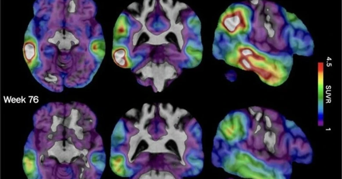 Experimental Alzheimer’s drug lowers tau, may slow early decline