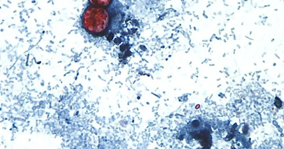 Cyclosporiasis cases rise as fresh produce comes under scrutiny