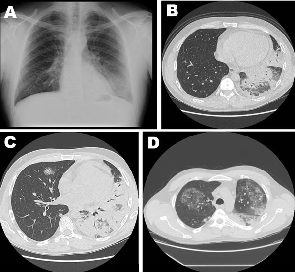 Legionnaires’ disease — Wikimedia Commons