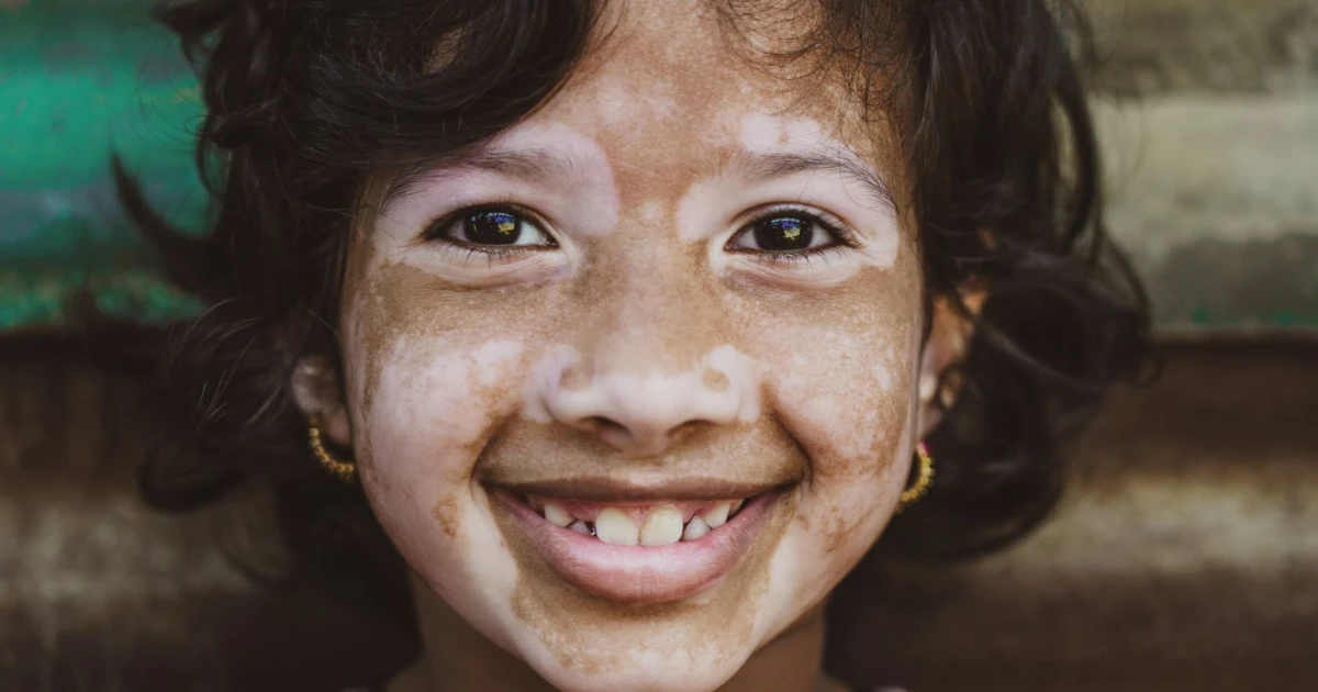 Pfizer says oral drug restores skin pigment in vitiligo trials